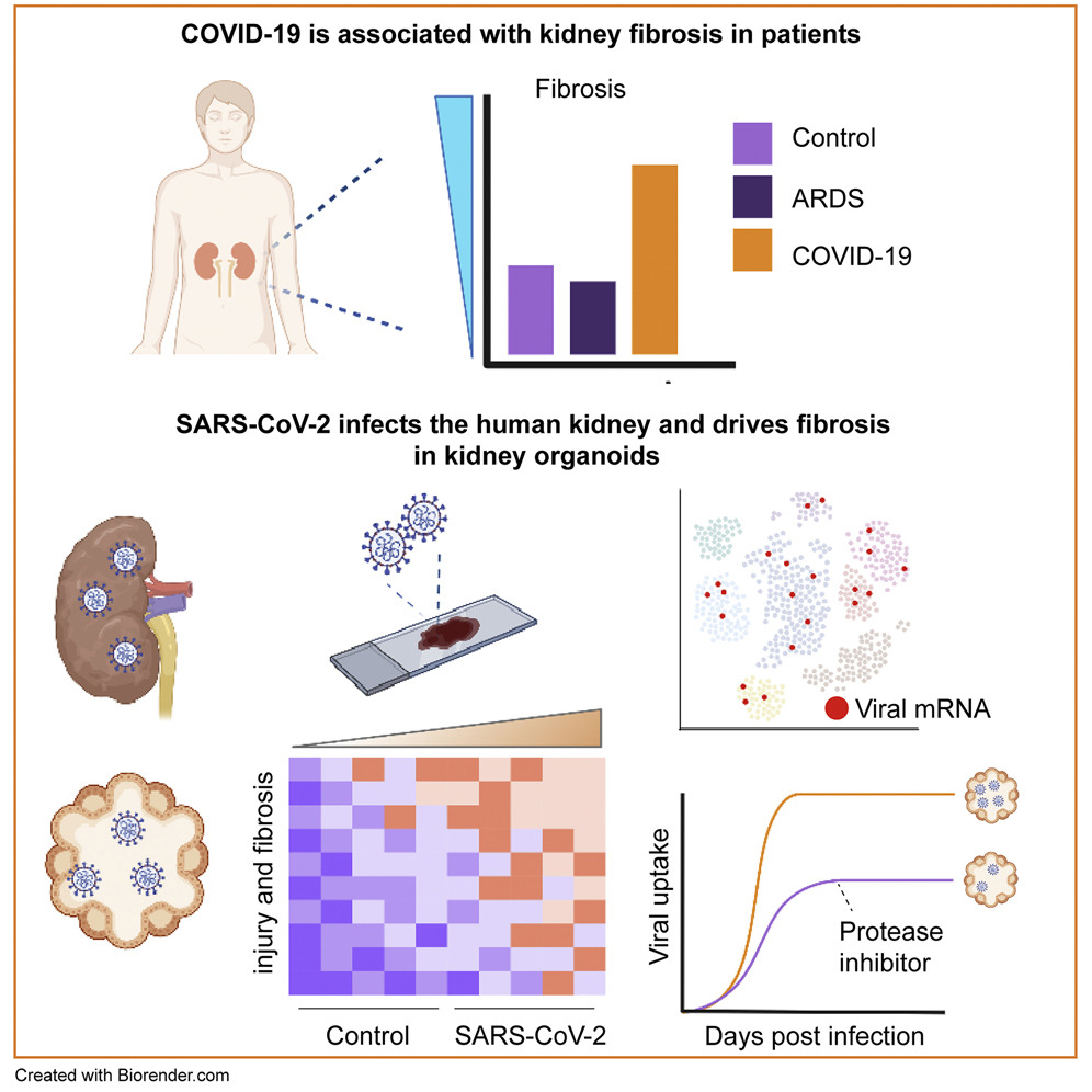 SARS-CoV-2 infects the human kidney and drives fibrosis in kidney organoids.