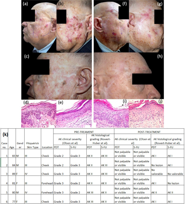 Clinical and histopathological study of actinic keratosis treatment with photodynamic therapy VS 5-fluorouracil for face cancerization.