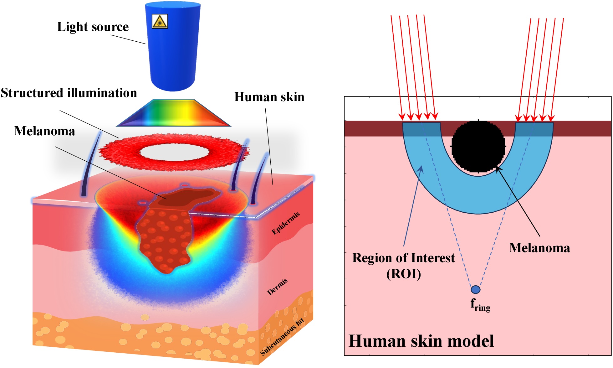 Photodynamic treatment of malignant melanoma with structured light: in silico Monte Carlo modeling.