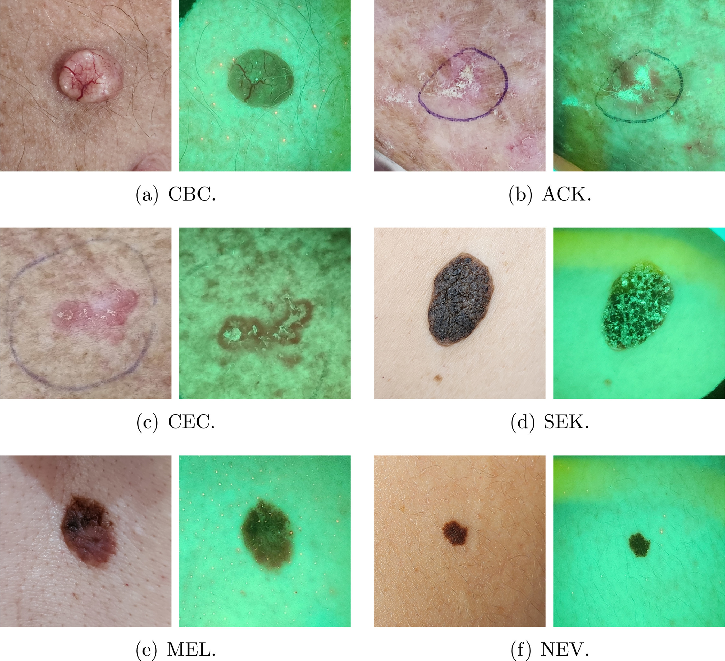 Fluorescence images of skin lesions and automated diagnosis using convolutional neural networks.