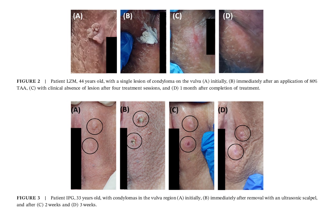 Comparative efficacy of ultrasonic scalpel surgery with photodynamic therapy versus trichloroacetic acid application in treating HPV-related condyloma acuminata: a randomized clinical trial.