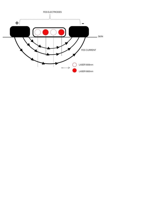 Synergistic effect of functional electrical stimulation (FES) and photobiomodulation in the rehabilitation of a patient with lumbar radiculopathy due to disc herniation: case report.