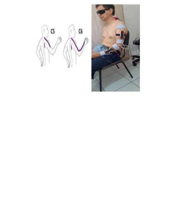 Transcutaneous electrical nerve stimulation (TENS) and photobiomodulation promote improvement in cervical radicular pain due to disc herniation? Case study.