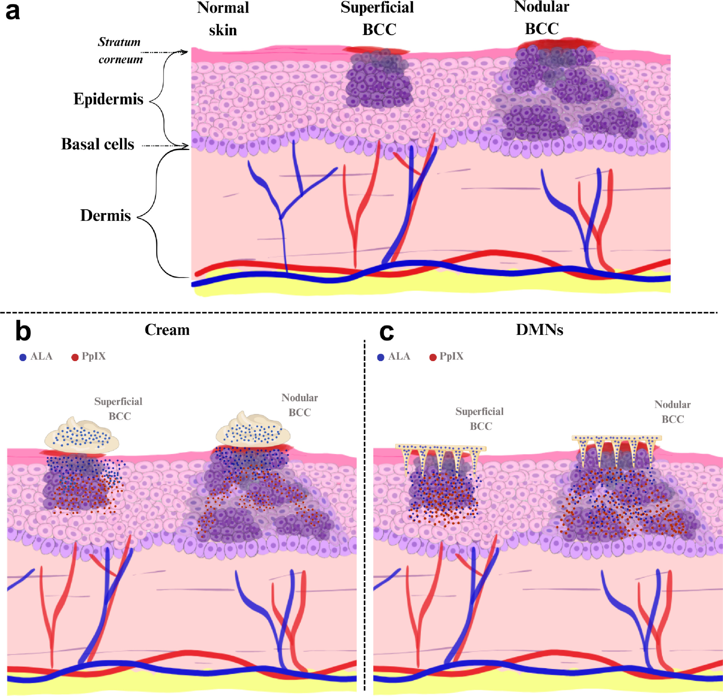 Scalable fabrication of polymeric dissolving microneedles for optimized ALA delivery in photodynamic therapy.