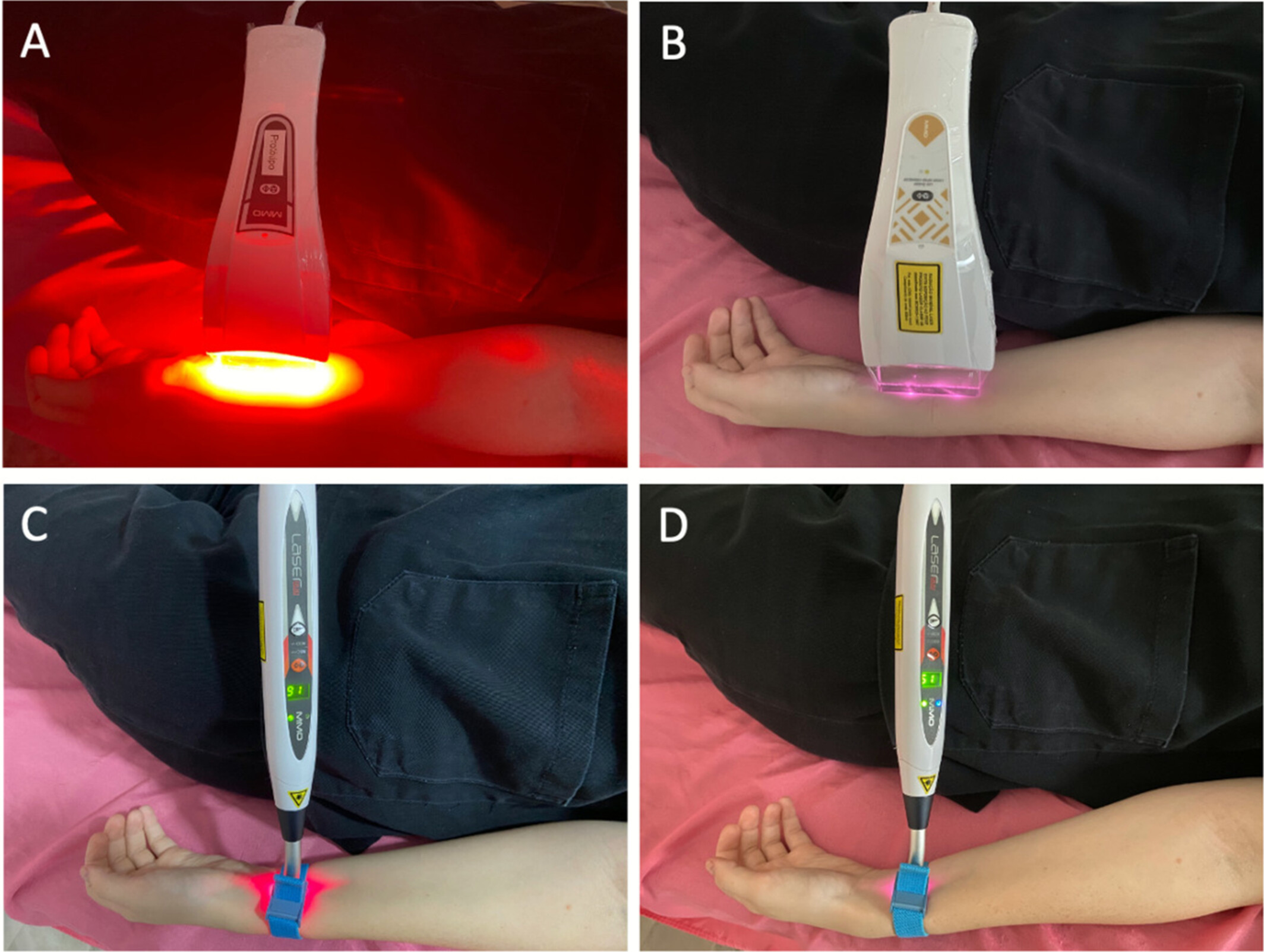 Protocol-dependent effects of transcutaneous blood systemic photobiomodulation on inflammatory, metabolic, and hemostatic markers.