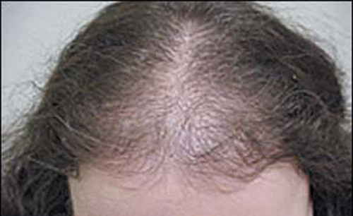 Chamada para tratamento da calvície (Alopecia Androgenética) em mulheres - Portal IFSC